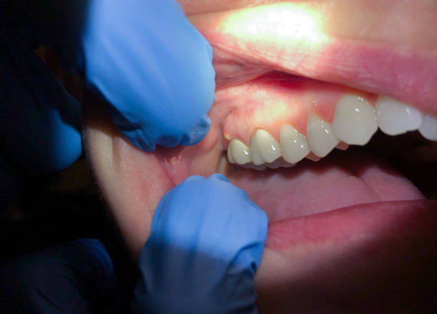 Best Emergency Dental Care for Sports Injuries in Mcloud, OK