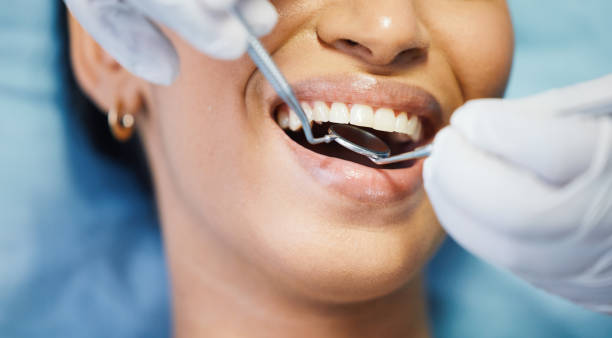 Best Knocked-Out Tooth (Avulsed Tooth) Treatment in Mcloud, OK